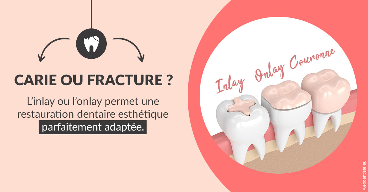 https://dr-renoux-alain.chirurgiens-dentistes.fr/T2 2023 - Carie ou fracture 2