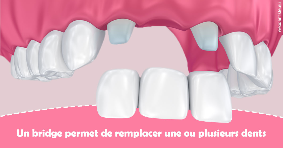 https://dr-renoux-alain.chirurgiens-dentistes.fr/Bridge remplacer dents 2