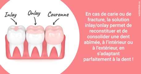 https://dr-renoux-alain.chirurgiens-dentistes.fr/L'INLAY ou l'ONLAY 2