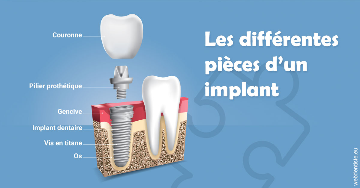 https://dr-renoux-alain.chirurgiens-dentistes.fr/Les différentes pièces d’un implant 1